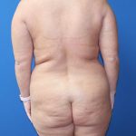 Tummy Tuck Before & After Patient #977