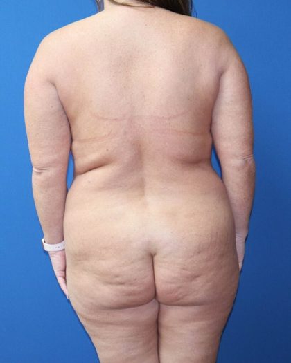 Tummy Tuck Before & After Patient #977