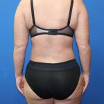 Tummy Tuck Before & After Patient #977