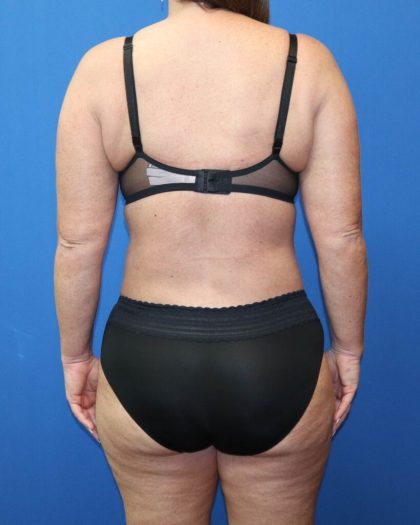 Tummy Tuck Before & After Patient #977