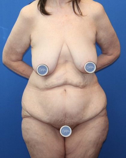 Tummy Tuck Before & After Patient #978