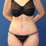 Tummy Tuck Before & After Patient #978