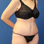 Tummy Tuck Before & After Patient #978