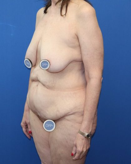 Tummy Tuck Before & After Patient #978