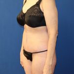 Tummy Tuck Before & After Patient #978