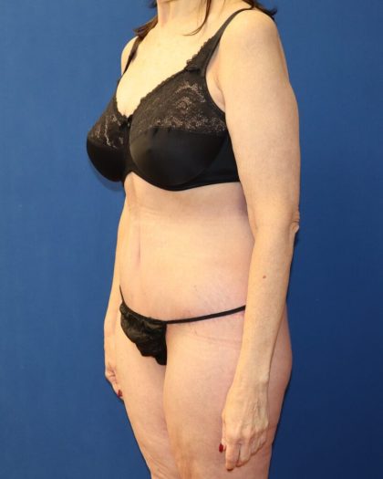 Tummy Tuck Before & After Patient #978