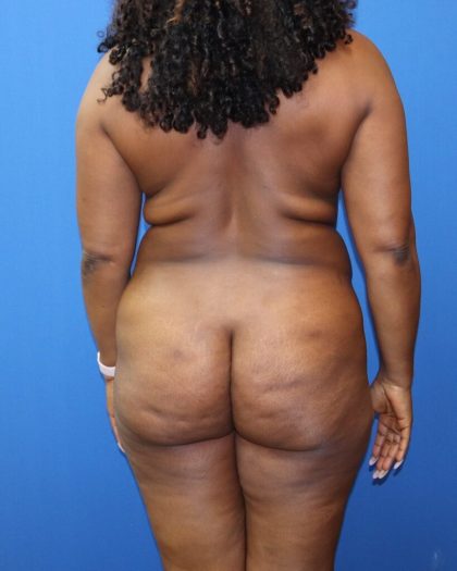 Tummy Tuck Before & After Patient #979