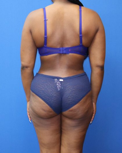 Tummy Tuck Before & After Patient #979