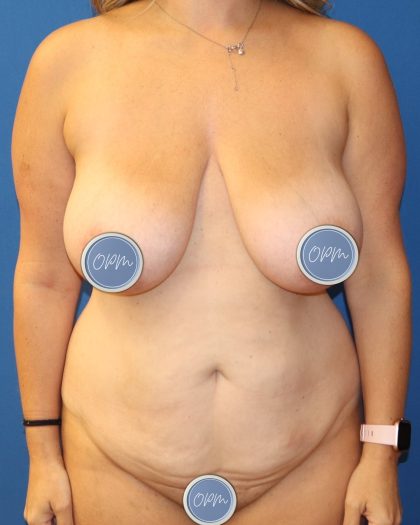 Tummy Tuck Before & After Patient #1480