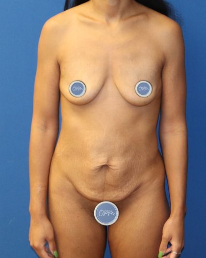Mini Tummy Tuck Before & After Patient #1519
