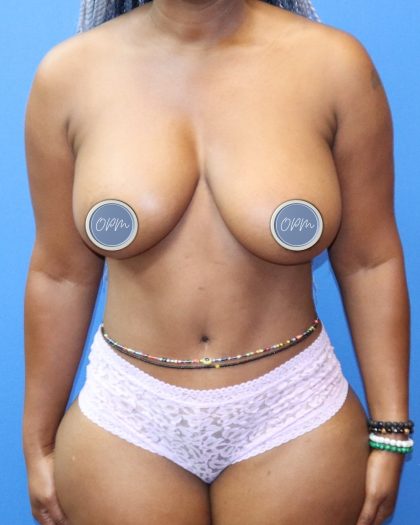 Breast Augmentation Before & After Patient #1521
