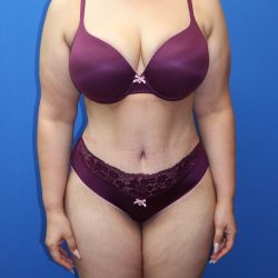 Tummy Tuck Before & After Patient #1530