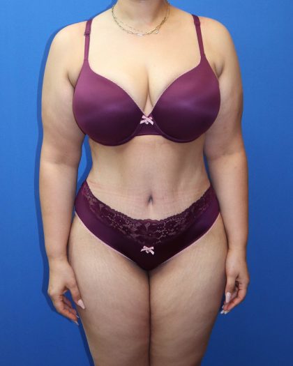 Tummy Tuck Before & After Patient #1530