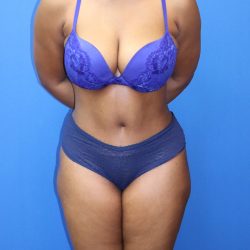 Tummy Tuck Before & After Patient #1481