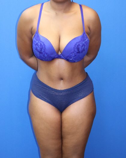 Tummy Tuck Before & After Patient #1481