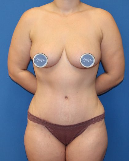 Tummy Tuck Before & After Patient #1477