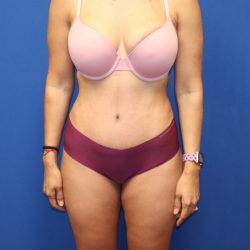 Tummy Tuck Before & After Patient #1483