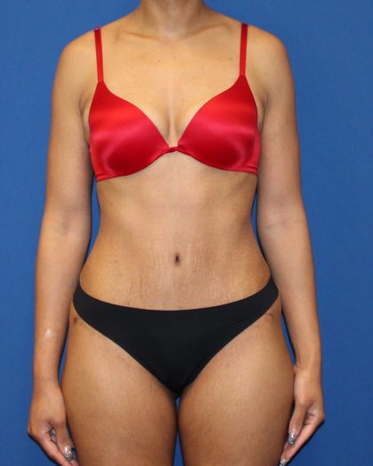 Mini Tummy Tuck Before & After Patient #1519