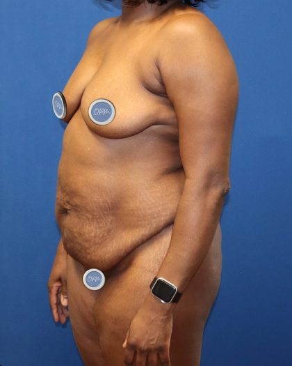 Breast Augmentation Before & After Patient #1484