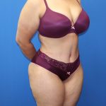 Tummy Tuck Before & After Patient #1530