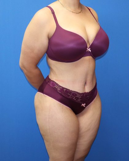Tummy Tuck Before & After Patient #1530