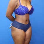 Tummy Tuck Before & After Patient #1481