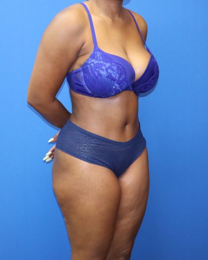 Tummy Tuck Before & After Patient #1481