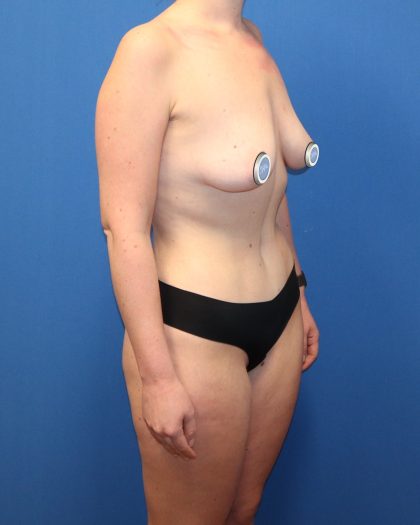 Tummy Tuck Before & After Patient #1482
