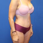 Tummy Tuck Before & After Patient #1483