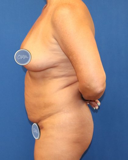 Tummy Tuck Before & After Patient #1515
