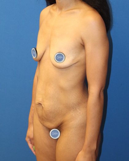 Mini Tummy Tuck Before & After Patient #1519