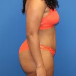Tummy Tuck Before & After Patient #1525