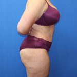 Tummy Tuck Before & After Patient #1530