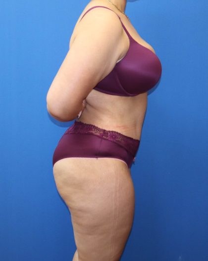 Tummy Tuck Before & After Patient #1530