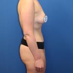 Tummy Tuck Before & After Patient #1482