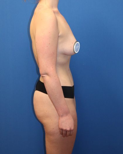 Tummy Tuck Before & After Patient #1482
