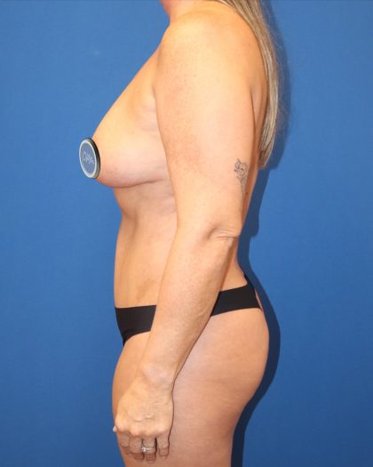 Tummy Tuck Before & After Patient #1515