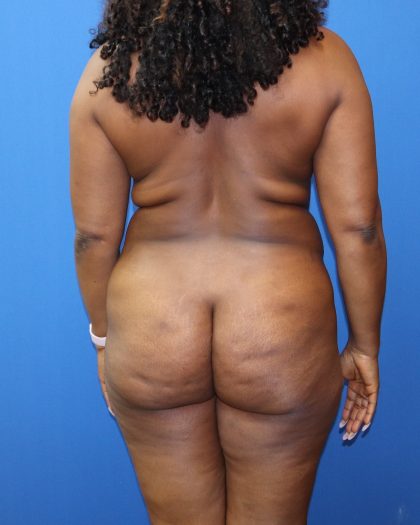 Tummy Tuck Before & After Patient #1481