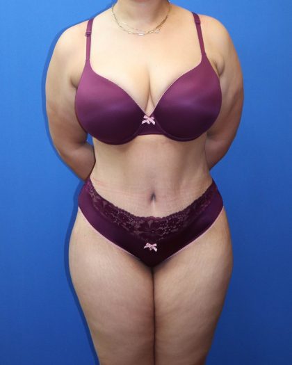 Tummy Tuck Before & After Patient #1530