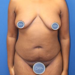 Tummy Tuck Before & After Patient #1852