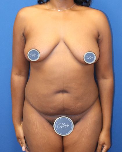 Tummy Tuck Before & After Patient #1852