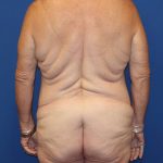 Back Lift Before & After Patient #1855