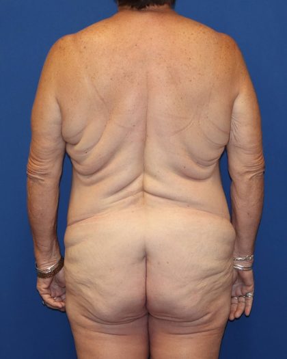 Back Lift Before & After Patient #1855