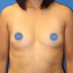Breast Augmentation Before & After Patient #1858
