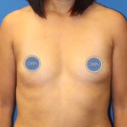 Breast Augmentation Before & After Patient #1858
