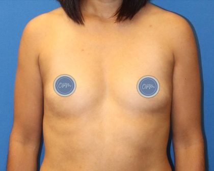 Breast Augmentation Before & After Patient #1858