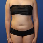 Liposuction 360 Before & After Patient #1865