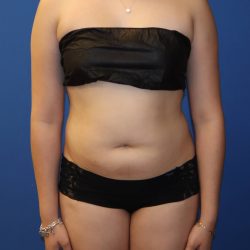 Liposuction 360 Before & After Patient #1865