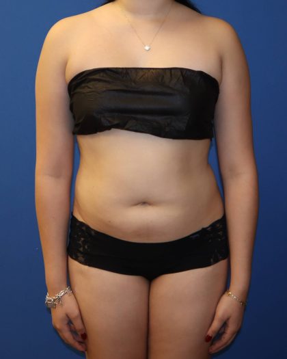 Liposuction 360 Before & After Patient #1865