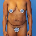 Tummy Tuck Before & After Patient #1844